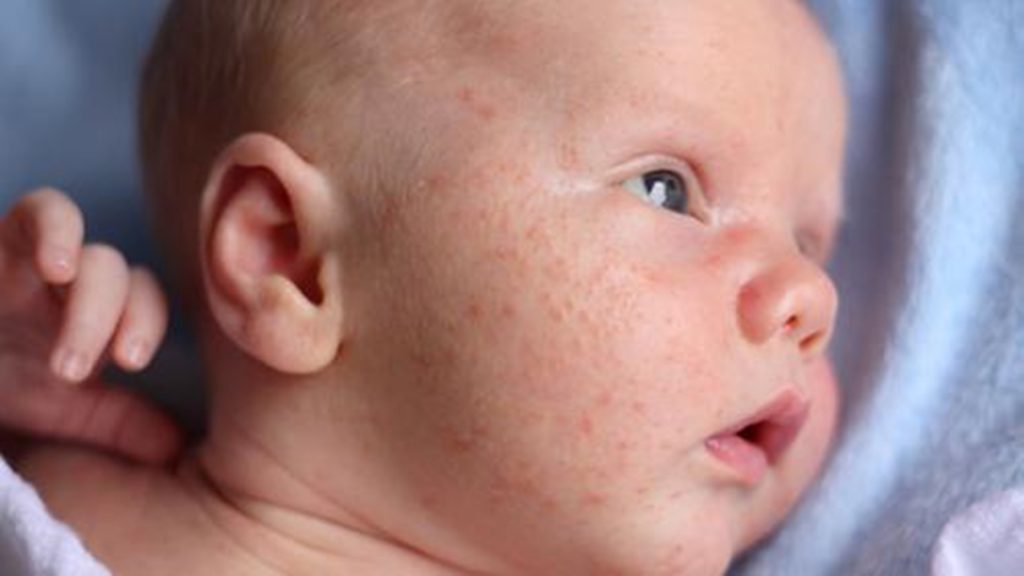 Cara Mengatasi Dermatitis Atopik pada Bayi