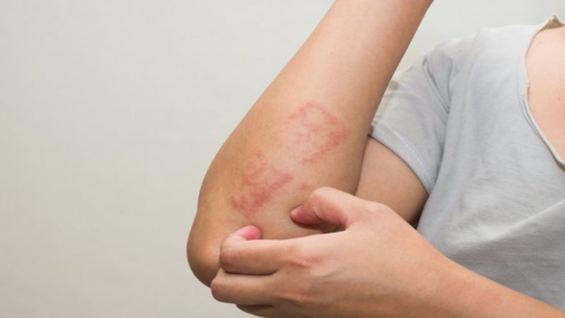 Penyakit Dermatitis : Gejala dan Cara Pencegahannya