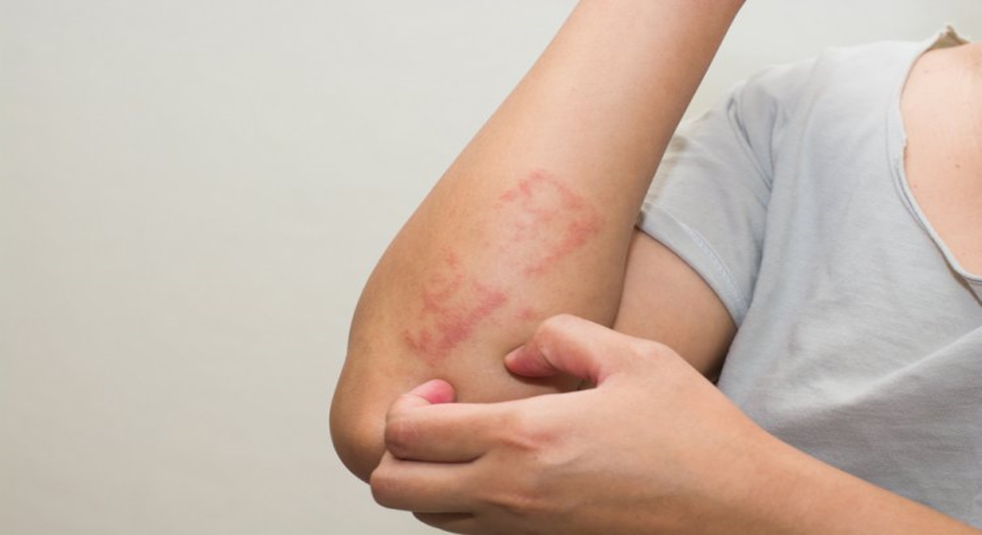 Penyakit Dermatitis : Gejala dan Cara Pencegahannya