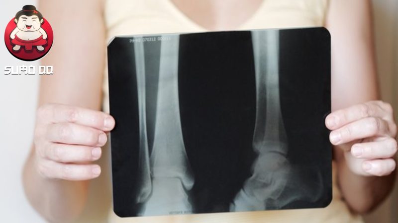 4 Cara Mudah Mencegah Munculnya Osteoporosis