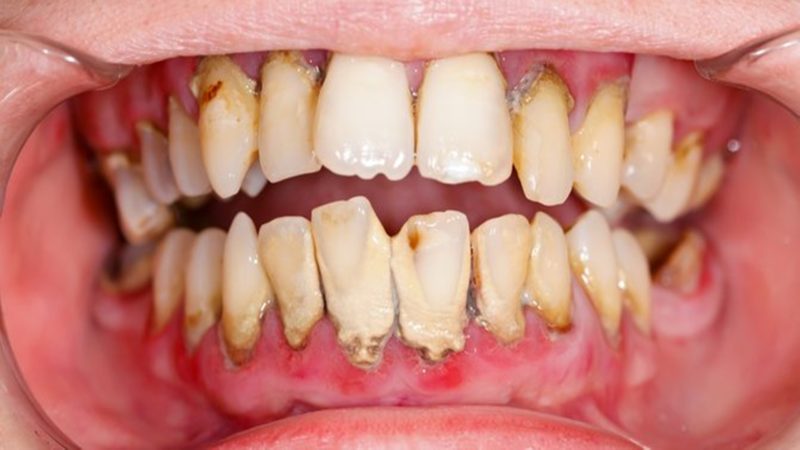 6 Cara Mudah Mencegah Terbentuknya Karang Gigi